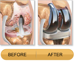 knee-replacement-surgery-2