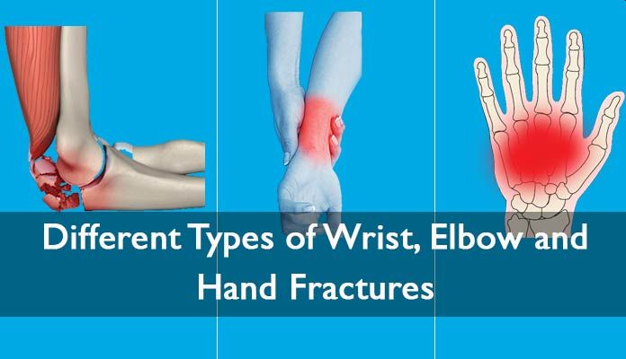 Elbow Wrist Fracture